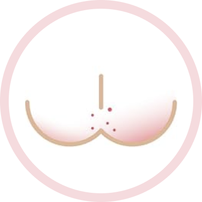 mild rash illustration