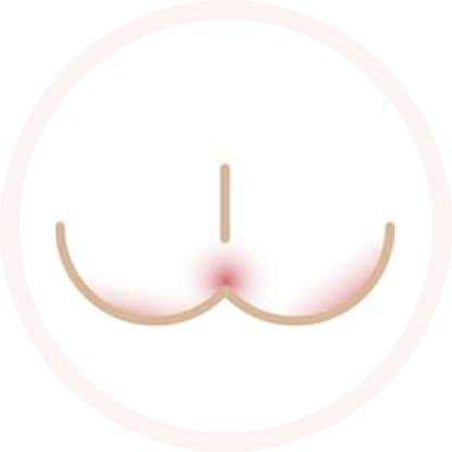 slight rash illustration