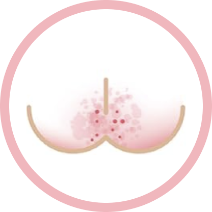 moderate rash illustration